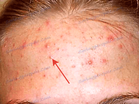 Odstranění velkých pimples ve Photoshopu (2)